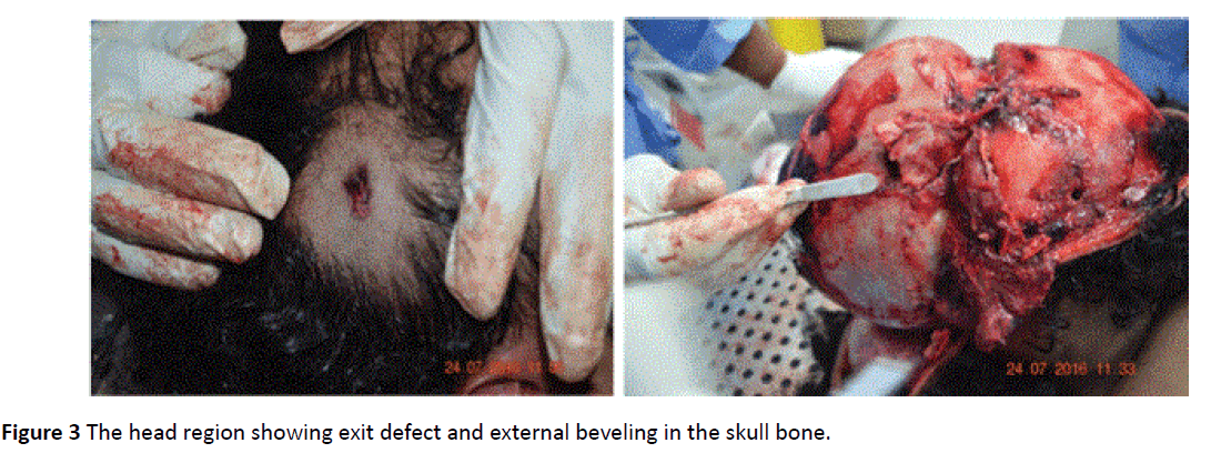 toxicology-external-beveling